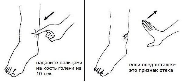 Лимфостаз нижних конечностей