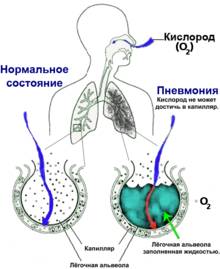 Чем пневмония отличается от воспаления легких?