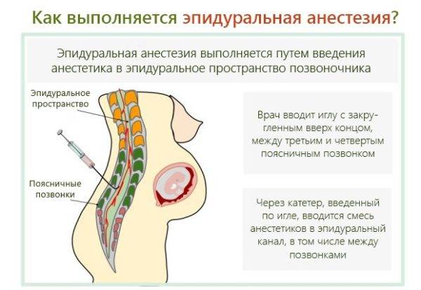 Болит спина после эпидуральной анестезии причины лечение