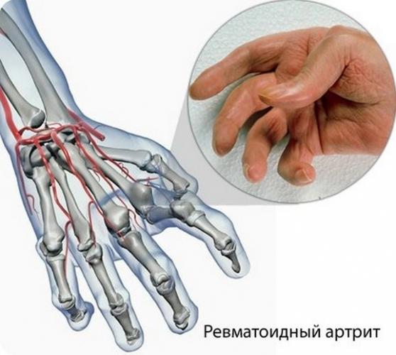 Основы правильного питания при полиартрите суставов
