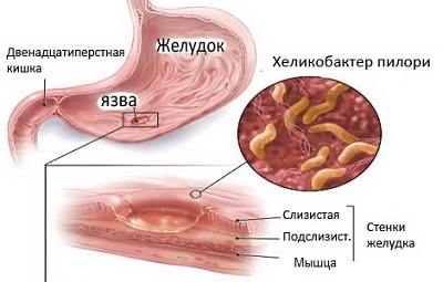 Почему лечение от хеликобактера вредно для здоровья - часть 2