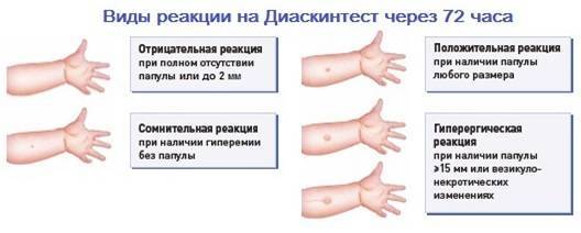 Диаскинтест: что это за тест, противопоказания, оценка результатов