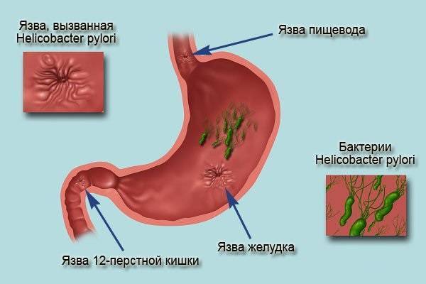 Коварный тайный враг – хеликобактер, виновник многих проблем в желудке