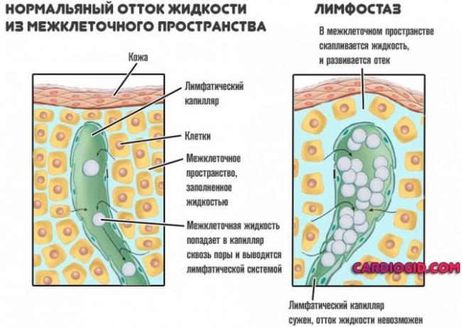 Лимфостаз нижних конечностей: лечение, симптомы, причины