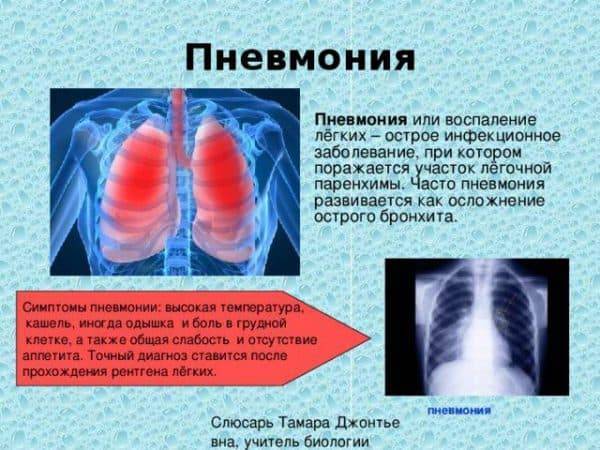 Пневмония у детей: симптомы, формы, лечение. советы врачей
