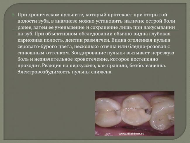 Симптомы и лечение пульпита