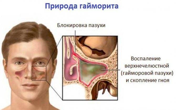 Народные средства от гайморита у взрослых в домашних условиях
