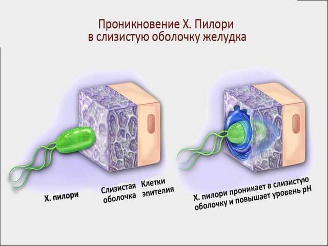 Коварная бактерия хеликобактер пилори, основные симптомы и лечение хеликобактериоза