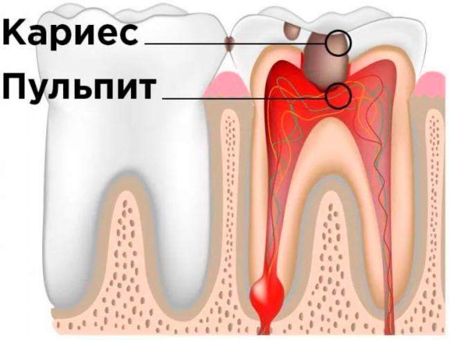 Острый, хронический, пульпит зуба мудрости: лечение и симптомы