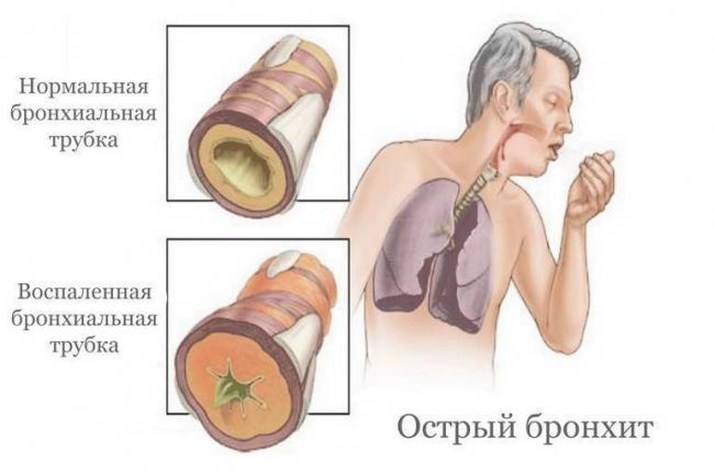 Лечение бронхита у детей народными средствами в домашних условиях