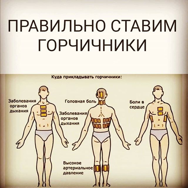 Рассказываем куда ставить горчичники при бронхите