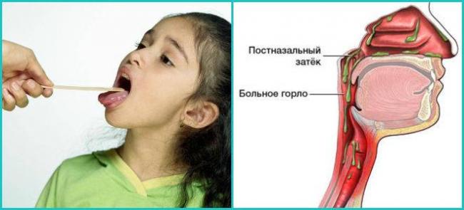 Густая мокрота без кашля лечение