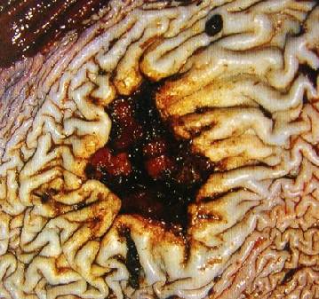 Язвенная болезнь: клиника течения, осложнения и терапия