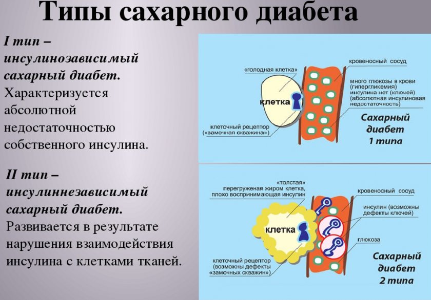 Сахарный диабет 1 типа