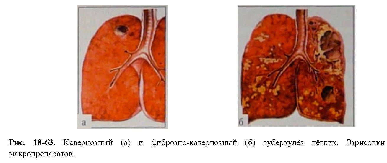 Фиброзно-кавернозный туберкулез