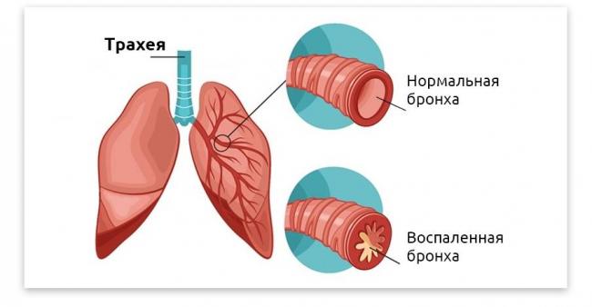 Хронический бронхит у взрослых — симптомы и лечение, причины, осложнения