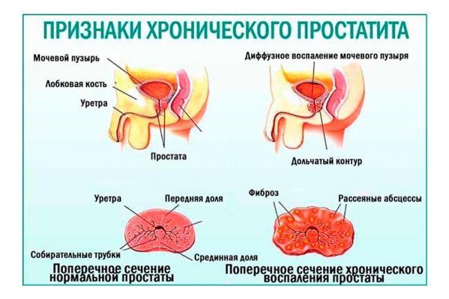 Влияет ли простатит на потенцию и эрекцию у мужчины? развеиваем мифы и разбираем факты