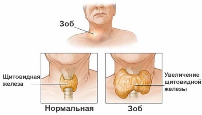 Эндемический зоб - лечение, симптомы, профилактика