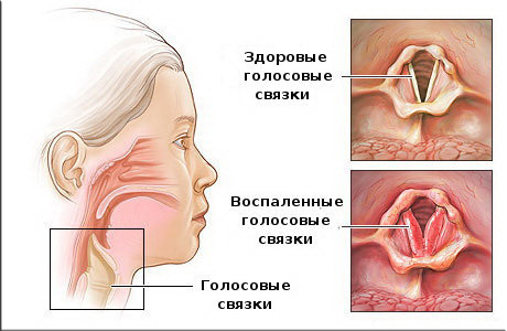 Ларингит