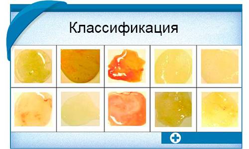 Особенности мокроты при бронхиальной астме, способы выведения экссудата