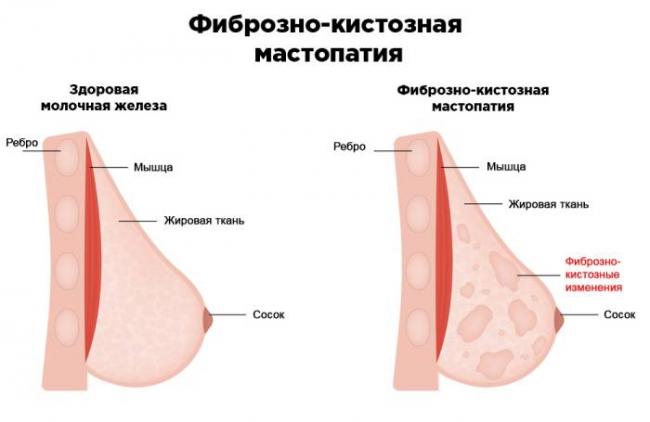 Мастопатия молочной железы – что это такое? фиброзно-кистозная мастопатия молочных желез – симптомы, лечение