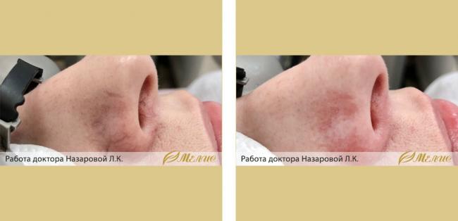 Сосудистые дефекты на лице: почему появляются и как с ними бороться?