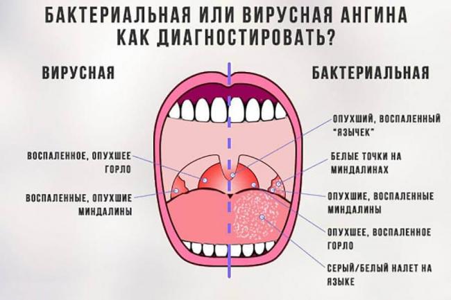 Воспаление миндалин: симптомы, лечение