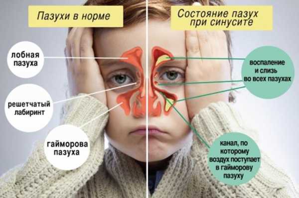 Очень густые зеленые сопли у ребенка чем лечить