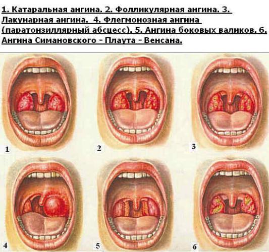 Лечение гнойной ангины народными средствами