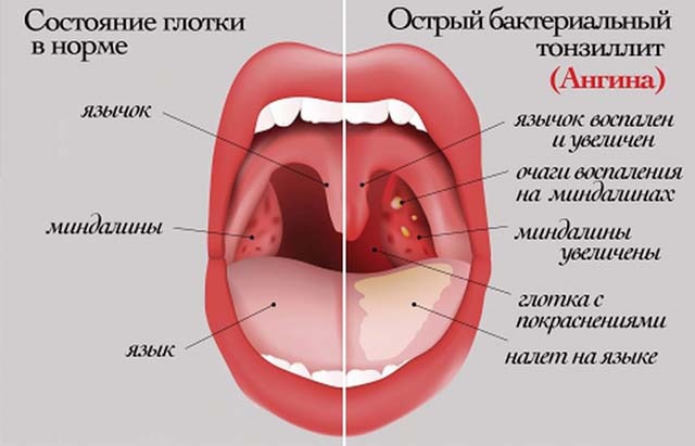 Причины, симптомы и лечение паратонзиллярного абсцесса