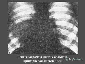 Прикорневая пневмония: симптомы, лечение, профилактика