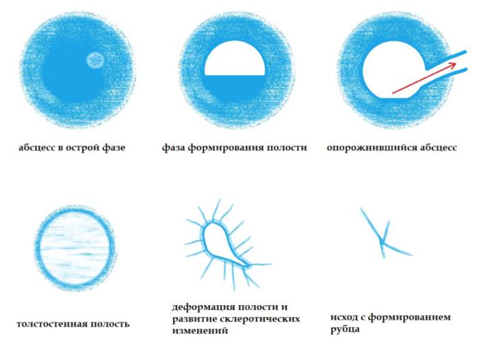 Хронический абсцесс легкого: симптомы, признаки, прогноз — онлайн-диагностика