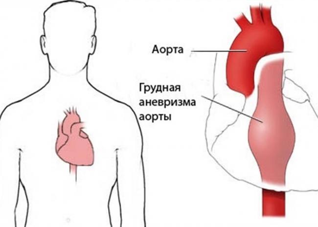Как спасают жизнь при разрыве аневризмы брюшной аорты?