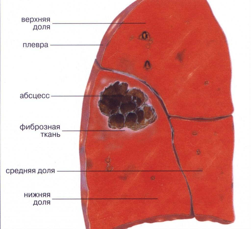 Острый абсцесс легкого: симптоматика и диагностика