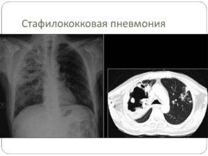 Стафилококковая пневмония симптомы