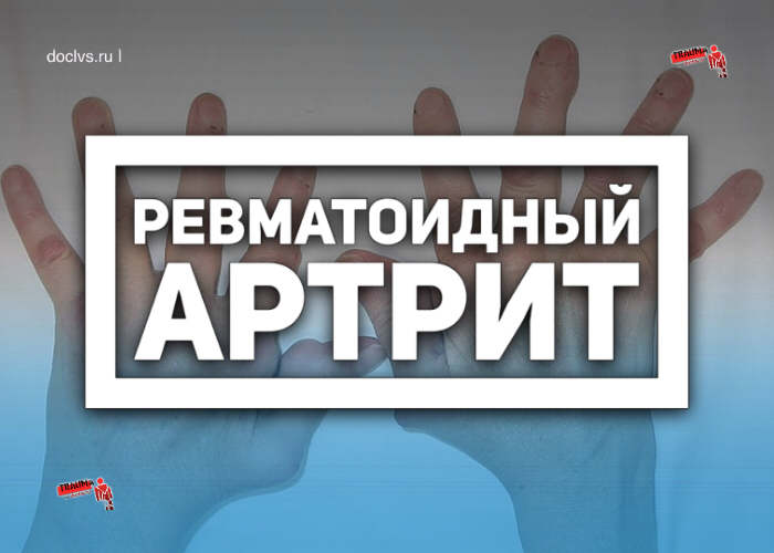 Ревматоидный артрит. причины, симптомы, современная диагностика и эффективное лечение болезни.