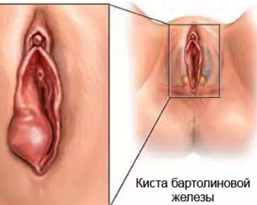 Бартолинит: что это такое и как лечить