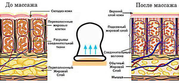 Массаж при ишиасе седалищного нерва: виды, техника выполнения, польза