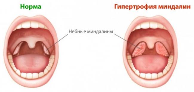 Воспаление миндалин: симптомы, лечение