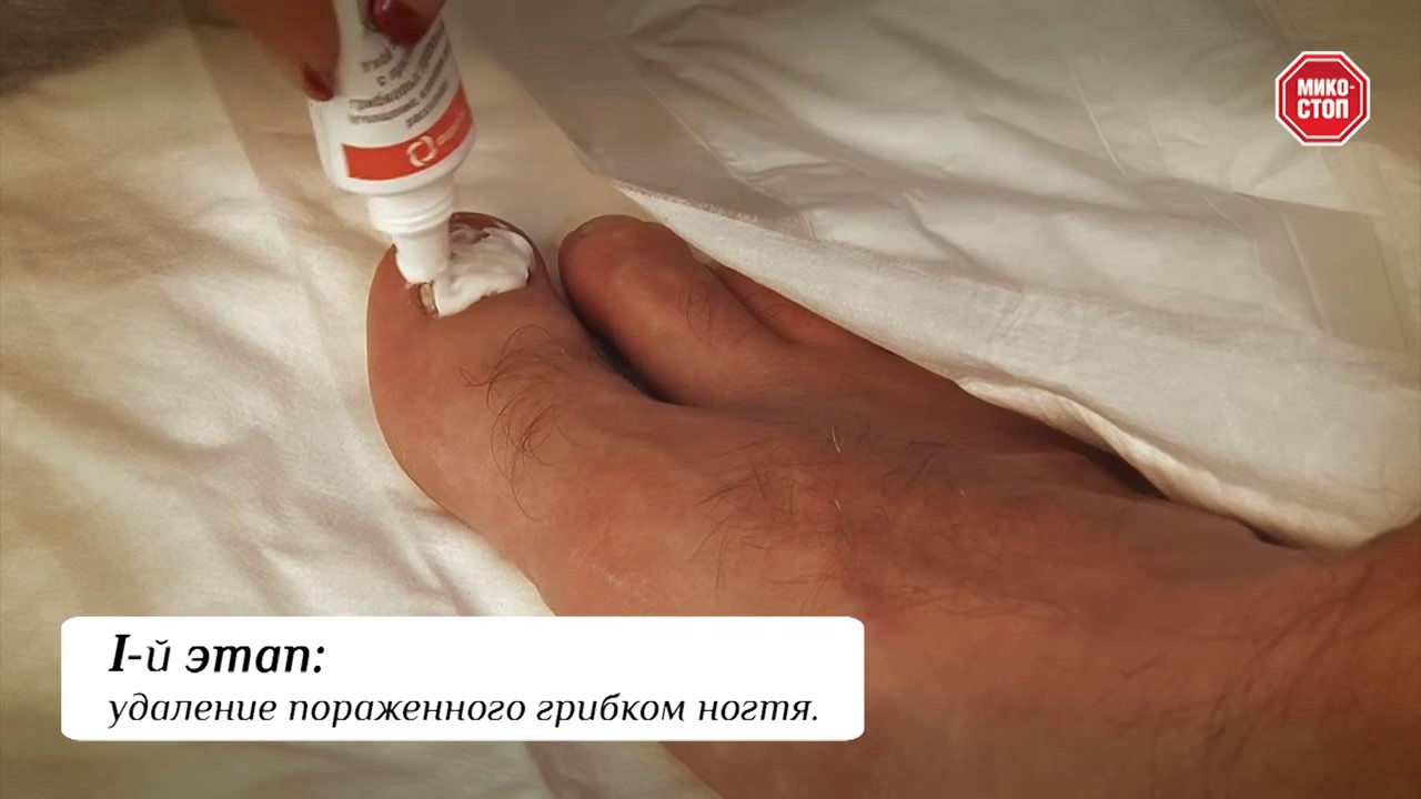 Микостоп: спрей, крем, лосьон, мазь от грибка