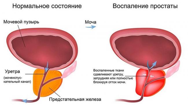Последствия простатита для мужчин