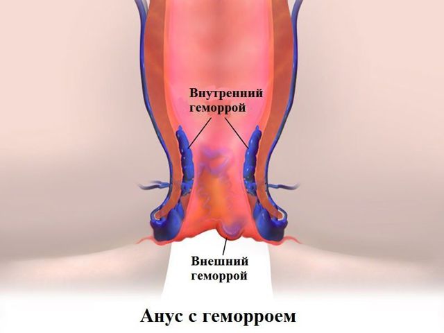 Чем отличается релиф адванс от релиф ультра?