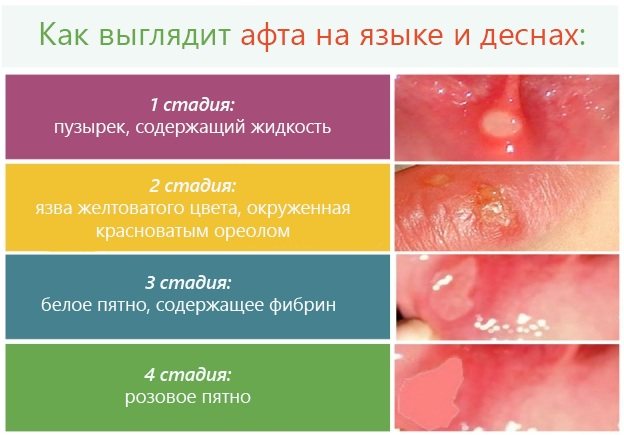 Лизобакт. инструкция по применению. цена, отзывы, аналоги