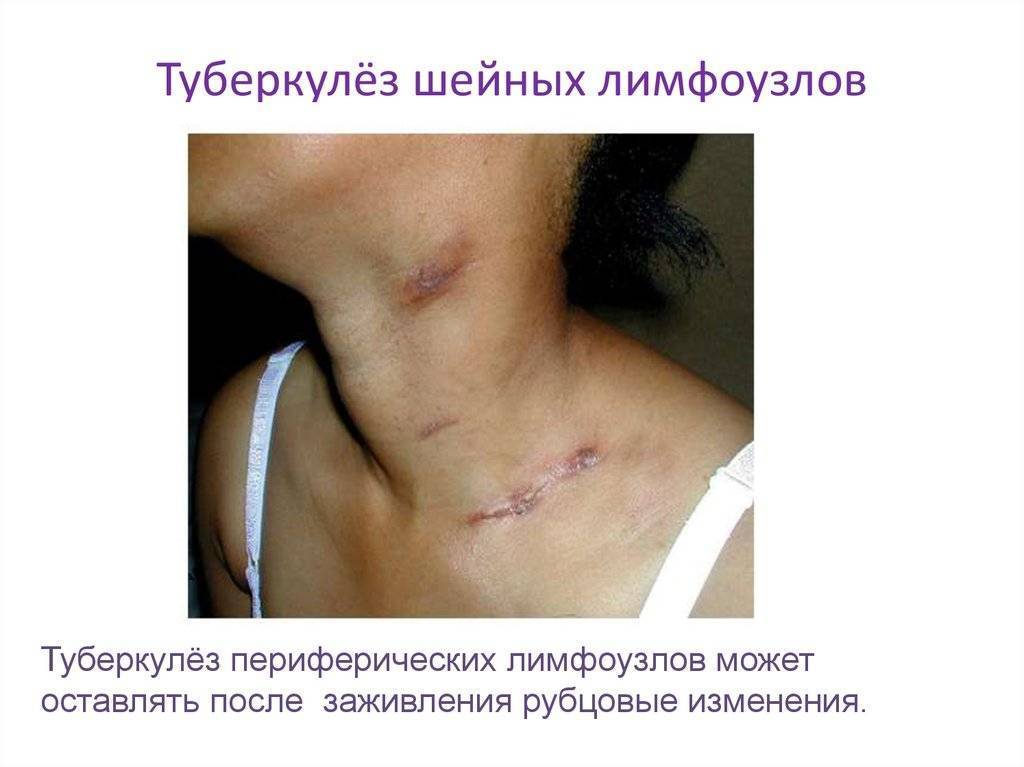 Туберкулез лимфатических узлов