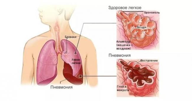 Может ли быть воспаление легких без температуры