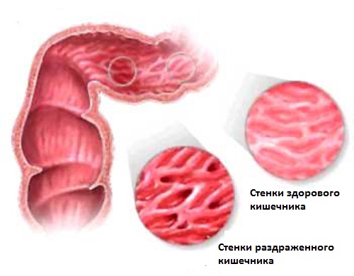 Диета при синдроме раздраженного кишечника (срк) в три шага