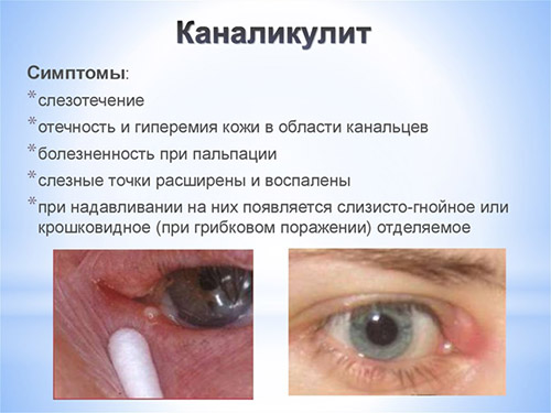 Воспаление слёзной железы: симптомы и лечение