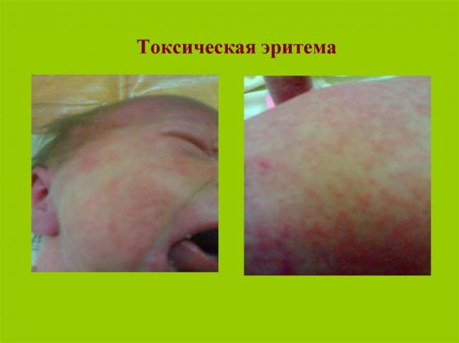 Инфекция цитомегаловирусная - симптомы и лечение