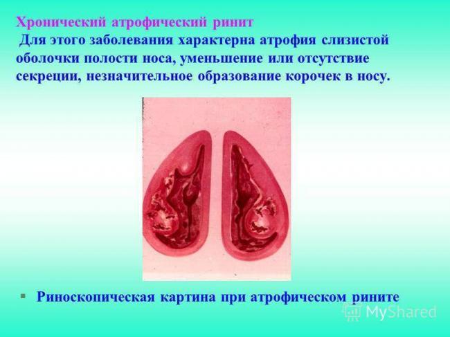 Сенной насморк - болезни носа и его придаточных пазух - справочник по оториноларингологии - мед читалка