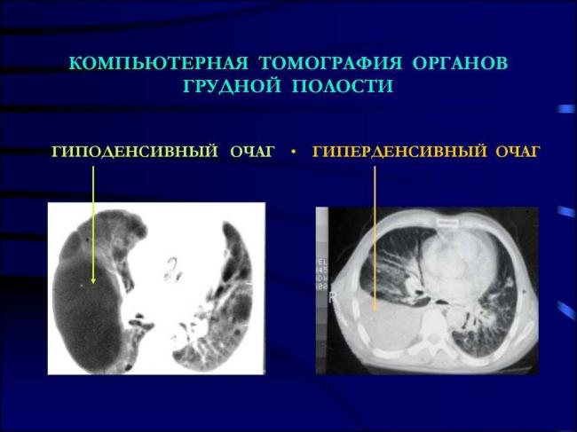 Единичные очаги в легких на кт что это может быть